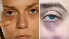 Tummat silmänaluset? Asiantuntijat listaavat pääasialliset syyt ja keinot niiden poistamiseksi